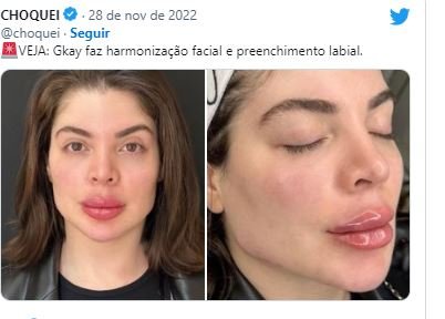 Gkay é comparada com personagem do Shrek após harmonização facial; confira